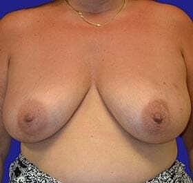 Breast Reconstruction Before & After