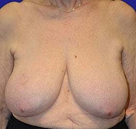 Breast Reconstruction Before & After