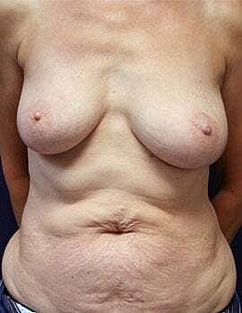 Breast Reconstruction Before & After