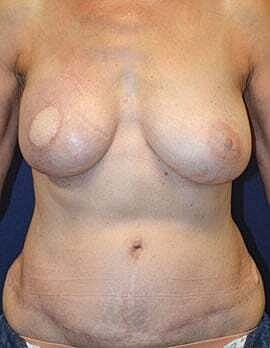 Breast Reconstruction Before & After