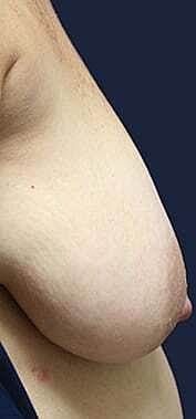 Breast Reconstruction Before & After