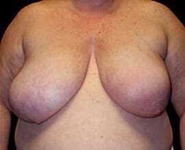 Breast Reconstruction Before & After
