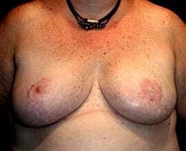 Breast Reconstruction Before & After