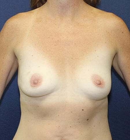 Breast Reconstruction Before & After