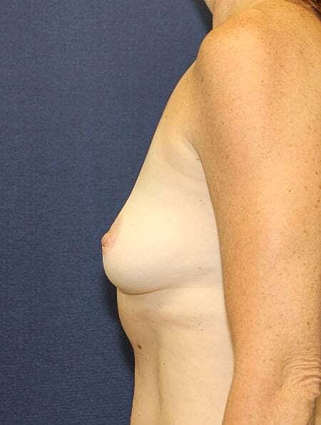Breast Reconstruction Before & After