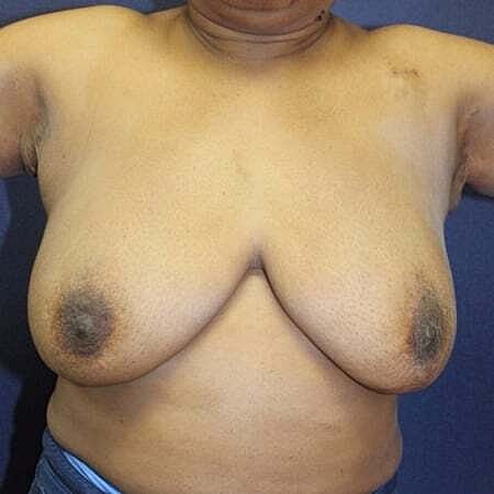 Breast Reconstruction Before & After