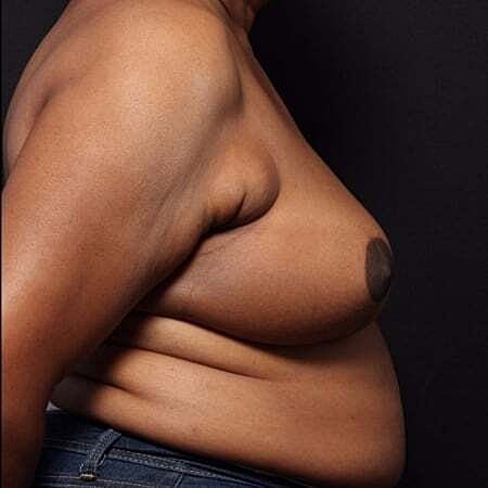 Breast Reconstruction Before & After