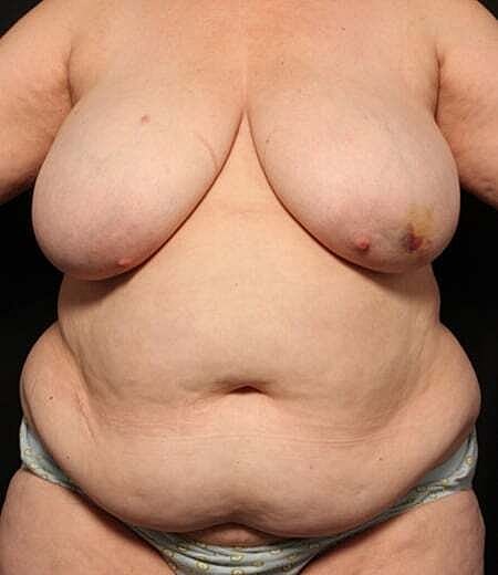 Breast Reconstruction Before & After
