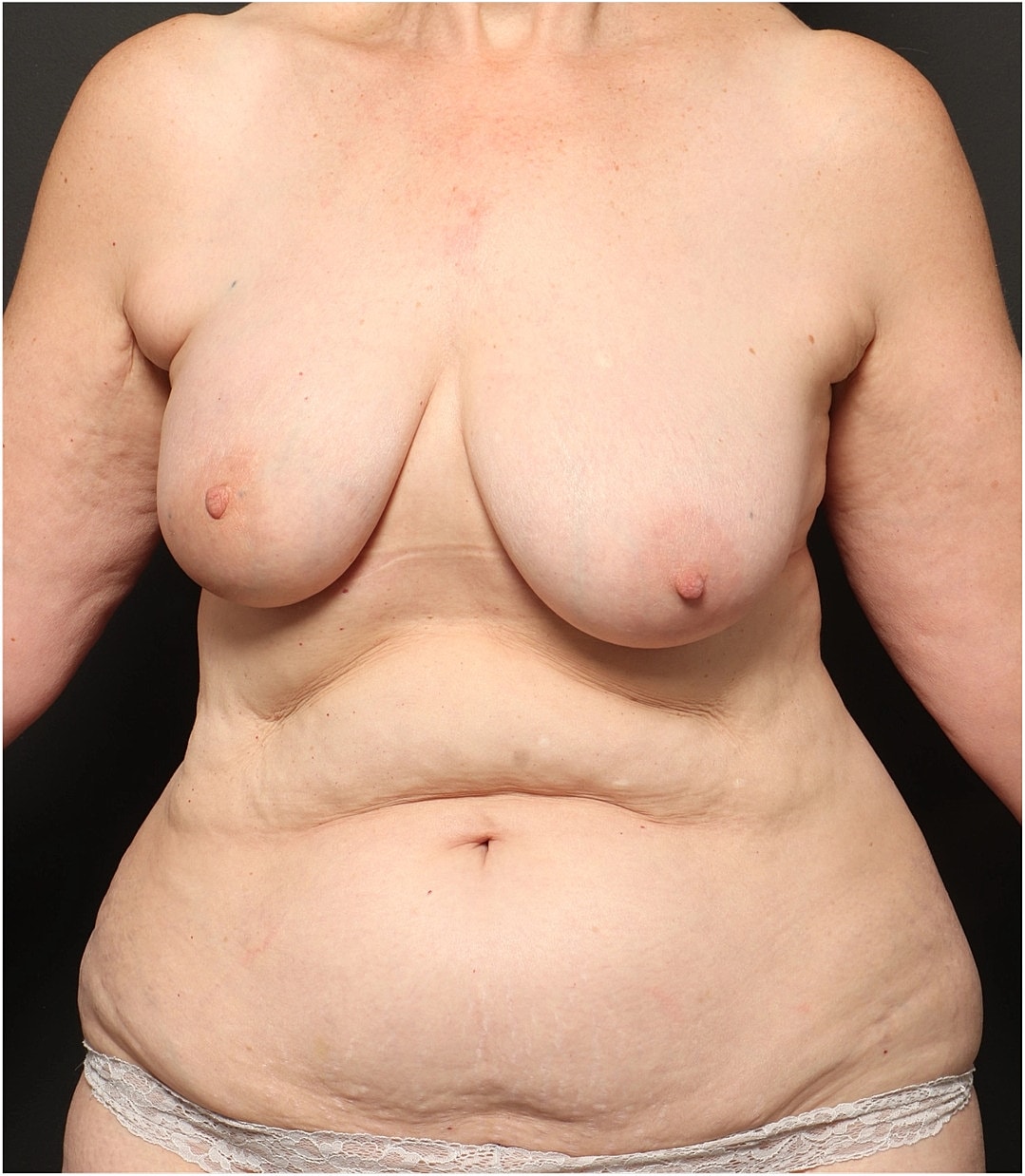 Breast Reconstruction Before & After