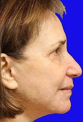 Facelift Before & After
