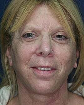 Facelift Before & After
