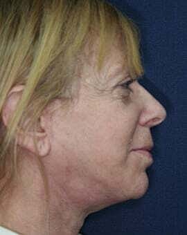 Facelift Before & After
