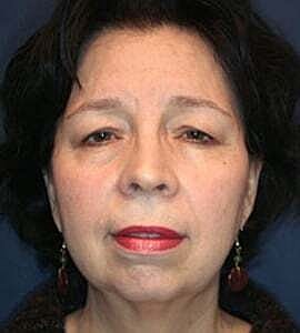 Facelift Before & After