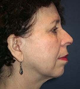 Facelift Before & After