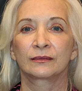 Facelift Before & After