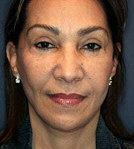 Facelift Before & After