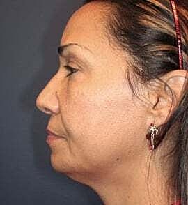 Facelift Before & After
