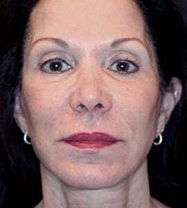 Facelift Before & After