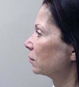 Facelift Before & After