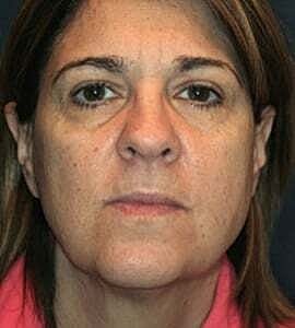 Facelift Before & After