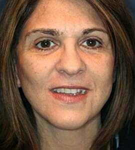 Facelift Before & After