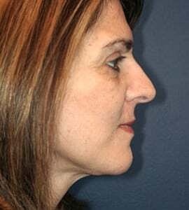 Facelift Before & After