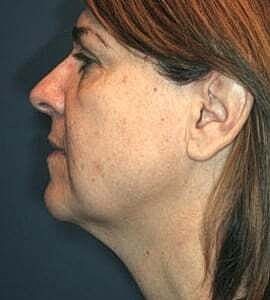 Facelift Before & After