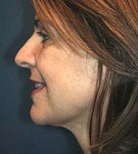 Facelift Before & After