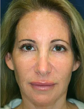 Cheeck Fillers Before and After