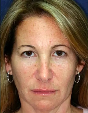 Cheeck Fillers Before and After
