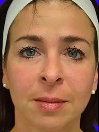 Cheeck Fillers Before and After
