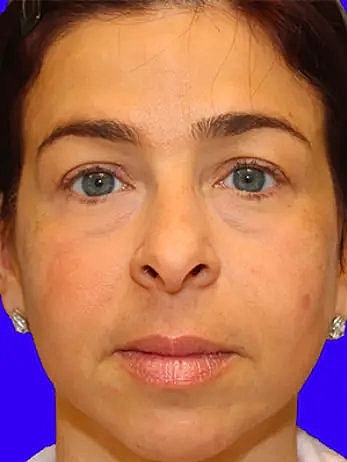 Cheeck Fillers Before and After