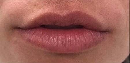 Lip Filler Before & After