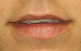 Lip Filler Before & After