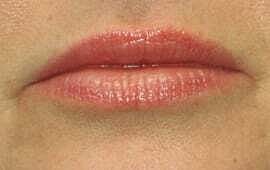 Lip Filler Before & After