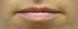 Lip Filler Before & After