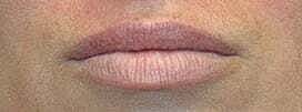 Lip Filler Before & After
