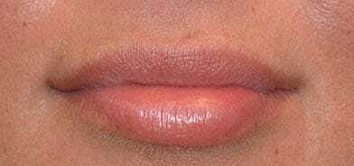 Lip Filler Before & After