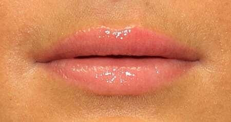 Lip Filler Before & After