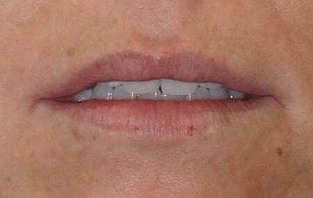 Lip Filler Before & After