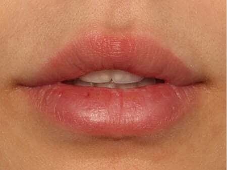 Lip Filler Before & After