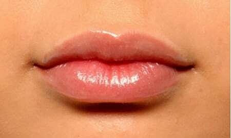Lip Filler Before & After