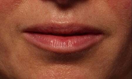 Lip Filler Before & After