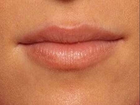 Lip Filler Before & After