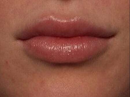 Lip Filler Before & After