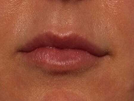 Lip Filler Before & After