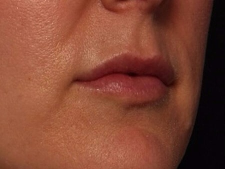 Lip Filler Before & After