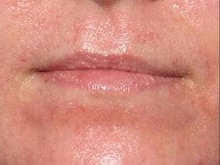Lip Filler Before & After