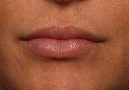 Lip Filler Before & After