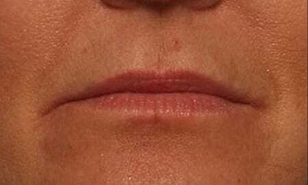 Lip Filler Before & After